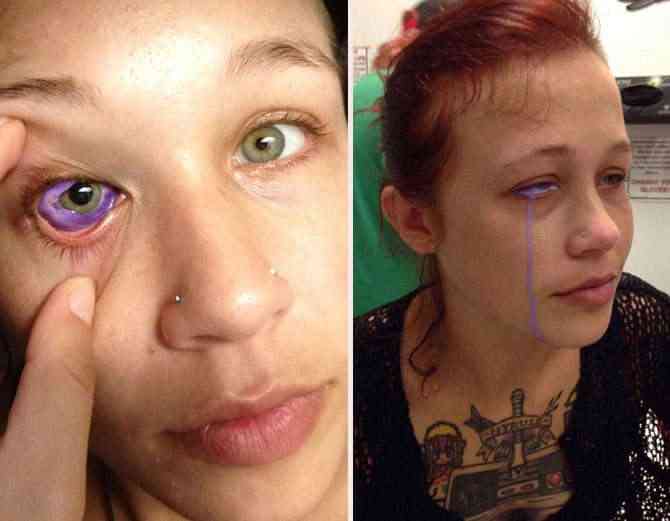 Woman who got an eyeball tattoo