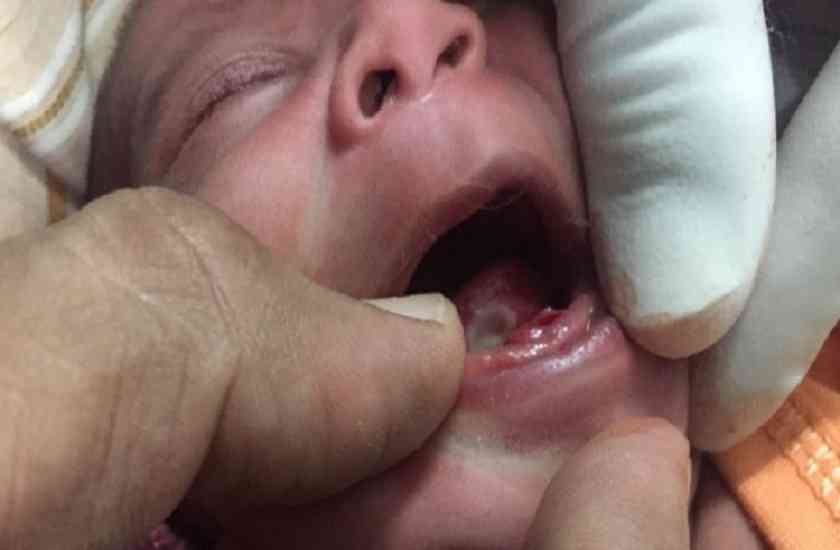 child,infant,teeth,neonatal,natal teeth,rare case medical history,phenomenon,