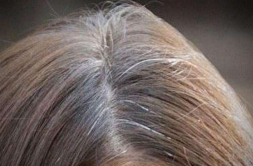 Premature grey hairs