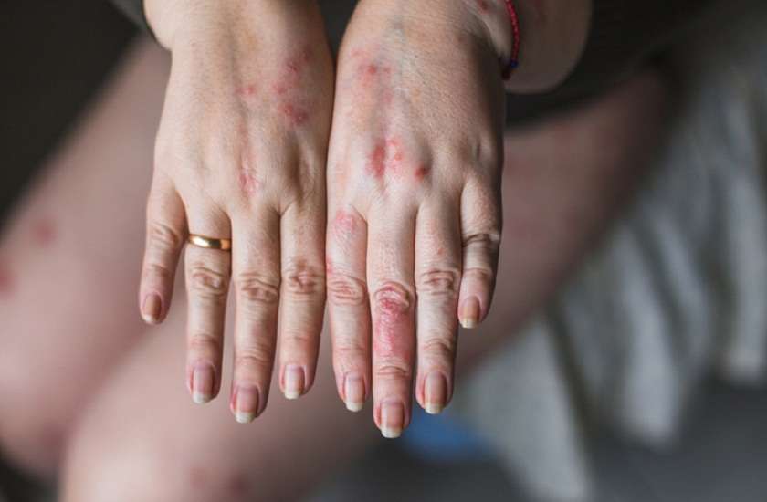 experts say smoking increases double the risk of psoriasis