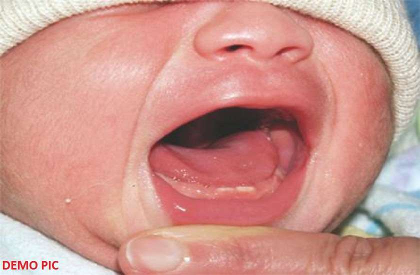 Newborn have 2 teeth