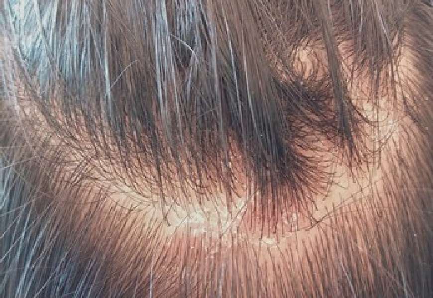 Hair Care Tips : अगर आप गंजेपन का शिकार हो रहे है तो इन तरीको को अपनाकर इससे बच सकते है