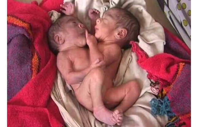 baby born with two heads