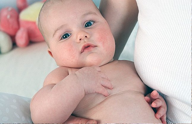 obesity in infants