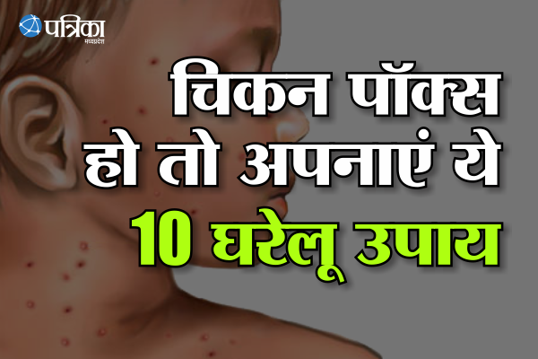 Home remedies for chicken pox
