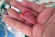 World smallest surviving baby