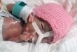 World smallest surviving baby