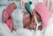 World smallest surviving baby