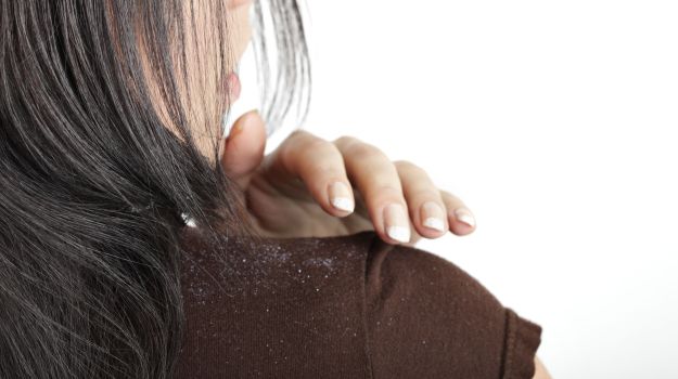 effective tips to get rid of dandruff