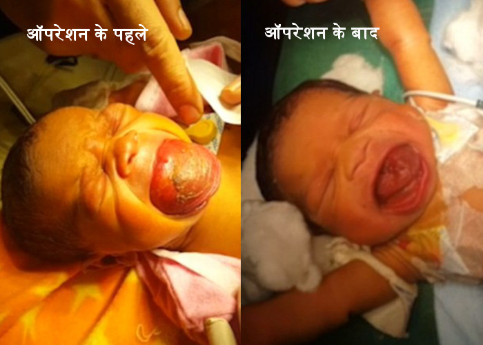 Baby born giant tongue, baby finally smile, baby b