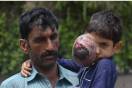 ali hassan eye tumour