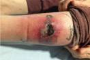 tattoo infection death 