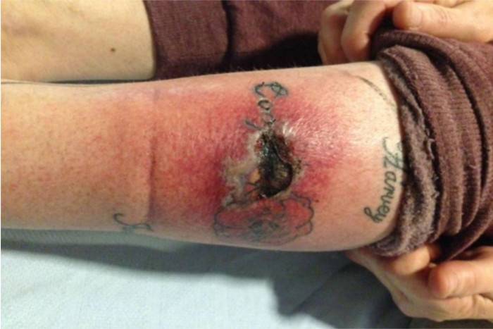 tattoo infection death