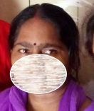 Acid Attaick Victims