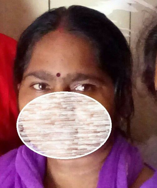 Acid Attaick Victims