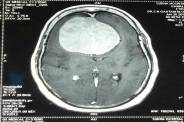 Doctor Remove 250 grams of lump from the woman's head in MBS Hospital Kota