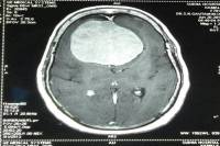 Doctor Remove 250 grams of lump from the woman's head in MBS Hospital Kota