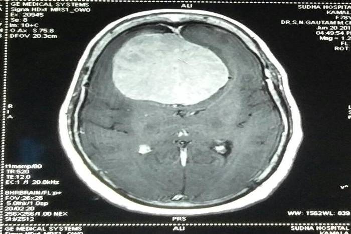 Doctor Remove 250 grams of lump from the woman's head in MBS Hospital Kota