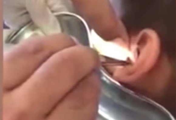 doctor remove dozens of squirming live MAGGOTS fro