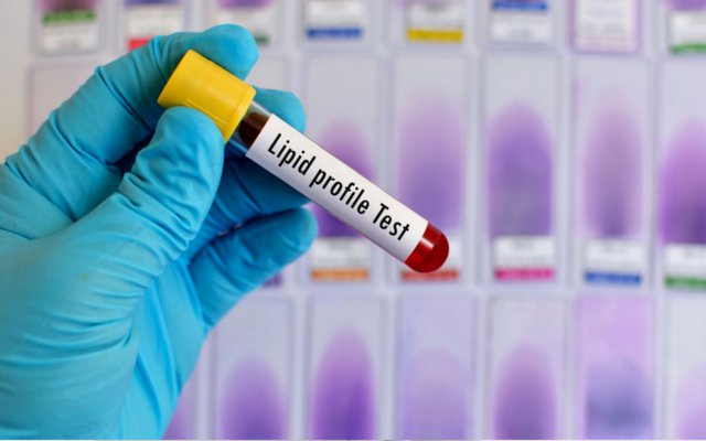 Lipid profile test