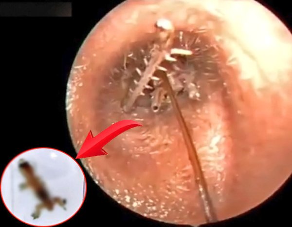 live lizard found from man ear