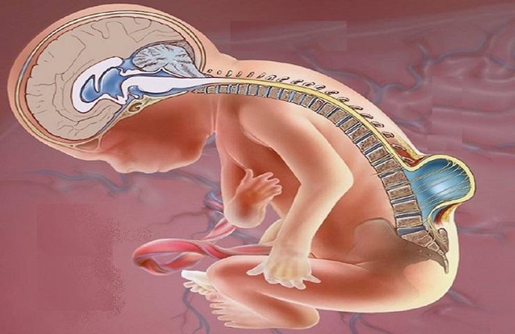 A Child Suffering From Meningocele Disease