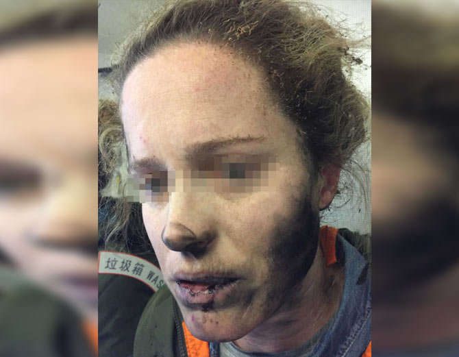 blast in headphone in flight caused facial burns
