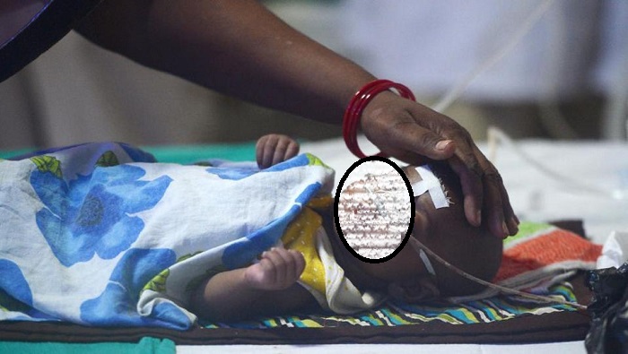 Japanese Encephalitis