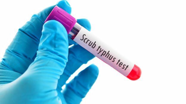 n-the-scrub-typhus-platelets-decrease-like-dengue-chikungunya