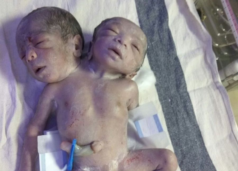Khandwa has two children born in the mouth