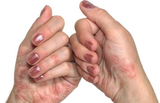 Psoriosis