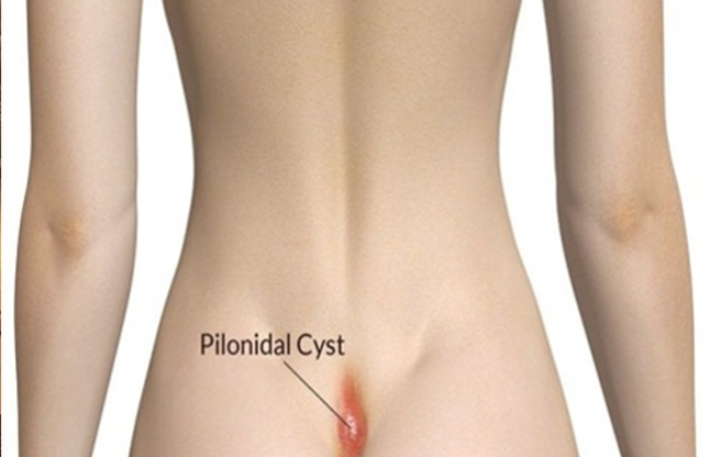 bacterial-infection-leads-to-pus-in-the-lump-of-the-hip-2005116