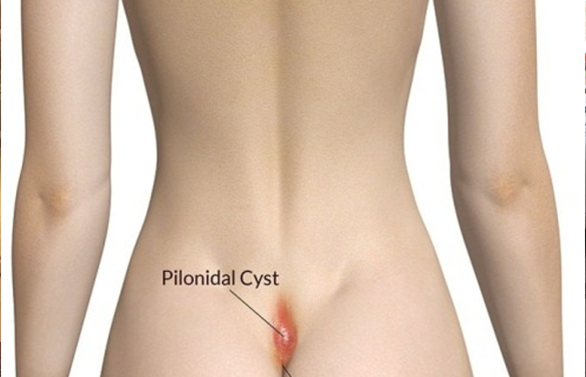 Bacterial infection leads to pus in the lump of the hip