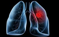 Lung cancer