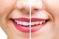 remove-the-yellowing-of-the-teeth