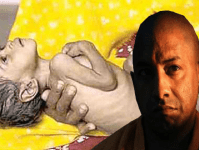 Malnourished children