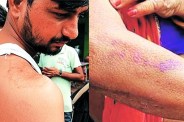 Skin Disease