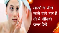 आंखों के नीचे काले गहरे दाग है तो ये वीडियो जरूर देखें