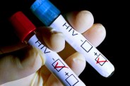 HIV 