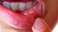 mouth ulcer