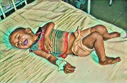 malnutrition