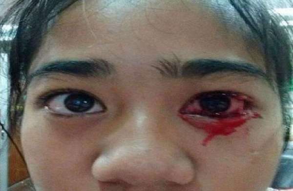 Thailand,doctors,girl,blood,health condition,Bloodshed,Strange disease,wound,Bleeding,
