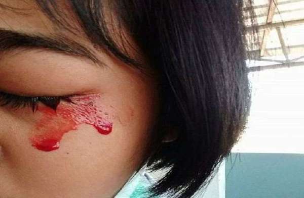 Thailand,doctors,girl,blood,health condition,Bloodshed,Strange disease,wound,Bleeding,