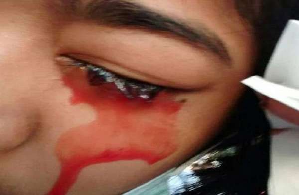 Thailand,doctors,girl,blood,health condition,Bloodshed,Strange disease,wound,Bleeding,