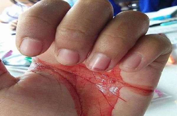 Thailand,doctors,girl,blood,health condition,Bloodshed,Strange disease,wound,Bleeding,