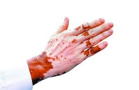 सफेद दाग