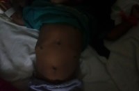 sick child stained with hot bars in Banswara