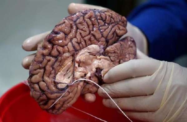 diseases,Britain,research,human brain,lab,preserve,parts of the human brain,