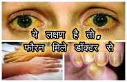 jaundice in raipur