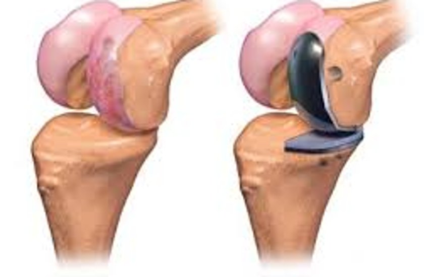 knee replacement surgery
